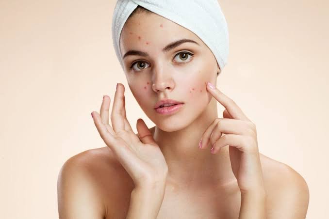 acne prone skin-acne products-j bijin